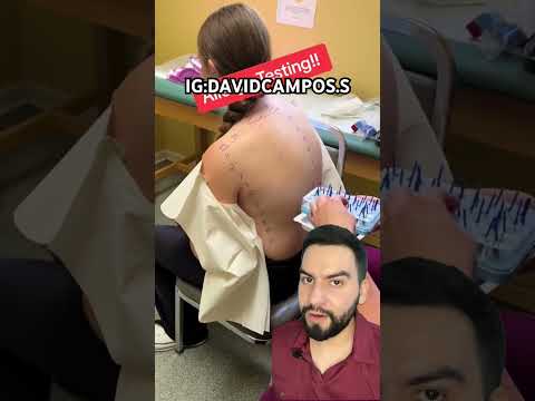 THIS IS HOW AN ALLERGY TEST IS PERFORMED