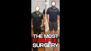 Height Enhancement Surgery's Excruciatingly Painful Procedure EXPLAINED