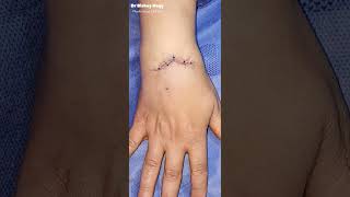 Ganglion Cyst