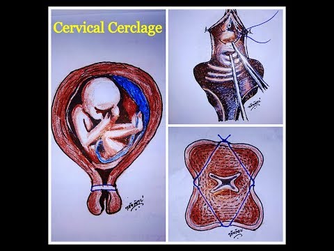 Cerclaje cervical - procedimiento de McDonald's