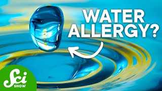 7 of the Strangest Allergies