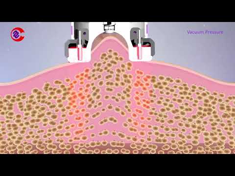 ¿Qué es la Vacumterapia?