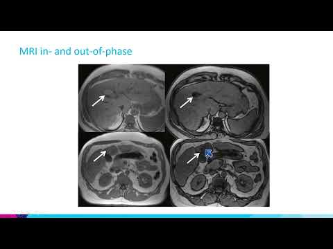 HCC and Cholangiocarcinoma by Bachir Taouli, M.D.