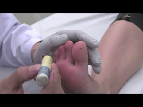 moxibustia verucilor genitale în izhevsk cancer de colon en mujeres jovenes sintomas