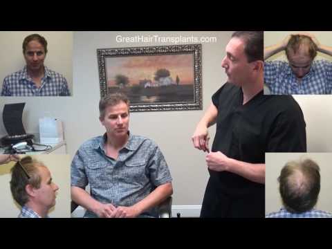 

Dr. Brett Bolton Hair Transplant Patient James from Alaska
