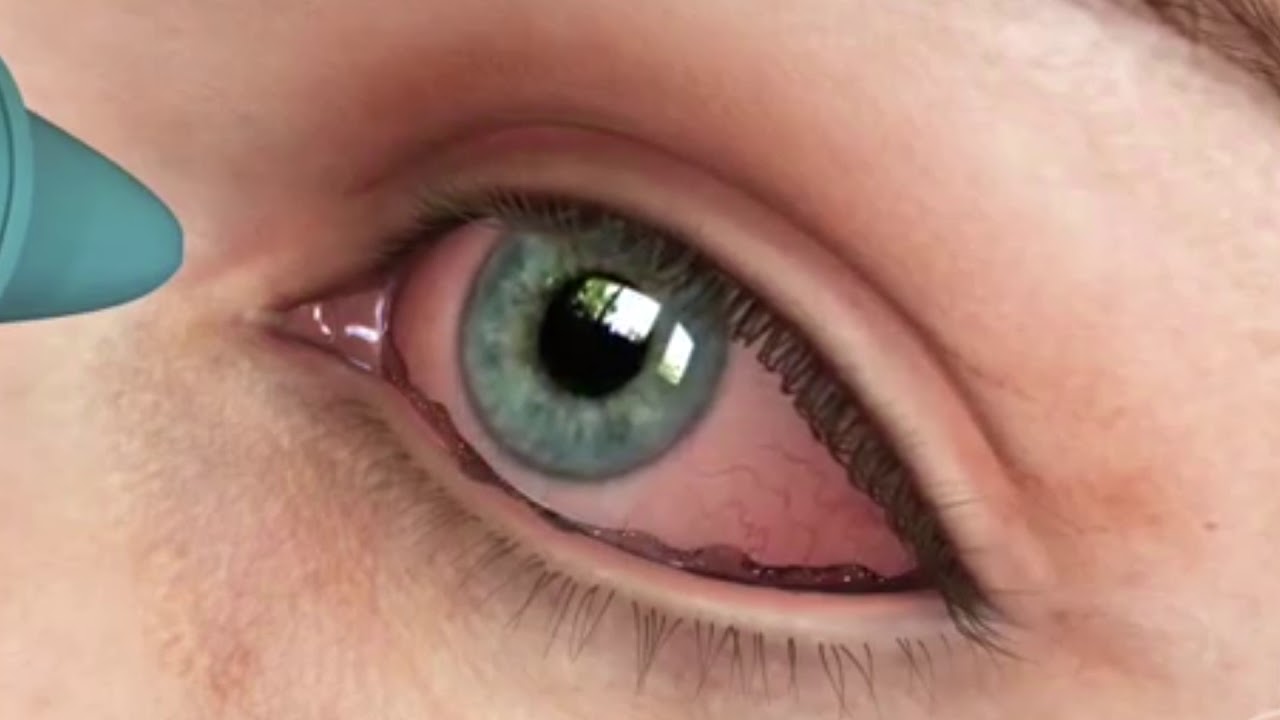 Medicina para todos: conjuntivitis