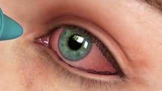 Medicina para todos: conjuntivitis