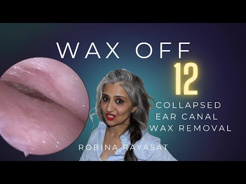 Collapsed  Ear Canal  Earwax Removal | Wax Off - Episode 12