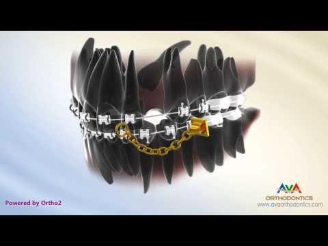 Orthodontic Treatment for Impacted Canine - Deep Surgical Exposure