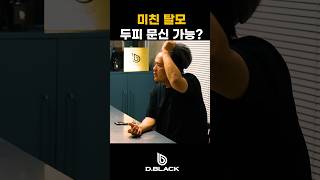 두피 문신 성형 시술