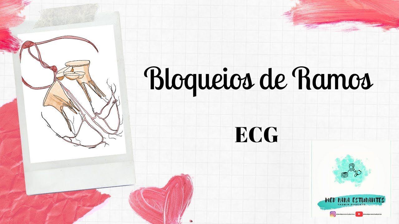 ECG- Bloqueios de Ramos (intraventriculares)