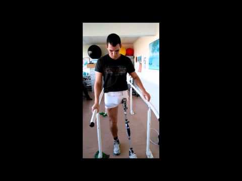 First time on prosthetic leg with hip disarticulation