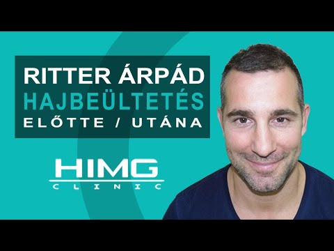 Ritter Árpád hajbeültetése - HIMG Hajátültetés Klinika