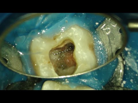Удаление сломанного инструмента из канала зуба 37