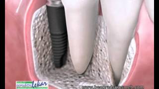 IMPLANT JE NAJBOLJA  ZAMENA ZA IZGUBLJENI ZUB