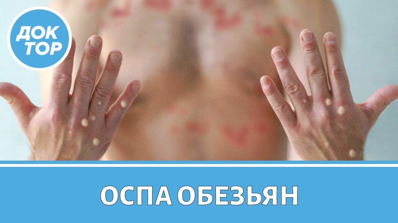 Как защитить себя и близких от обезьяньей оспы