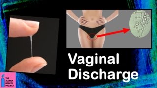 Vaginal Discharge │ What is Normal, What is Abnormal