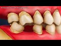 What Are The Consequences Of Missing Teeth