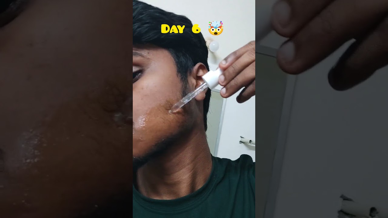 Day 6 😱 Using Man Matters Beard Kit | Unbelievable Growth 🔥#beardgrowth #minoxidil #minoxidilbeard