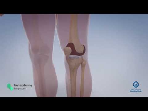 Behandlung zurück in den Nordosten Entzündung. Ellenbogen Bursitis