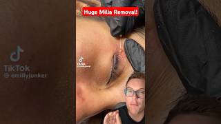 WORLDS BIGGEST MILIA REMOVAL - Huge Milia Under Eye #shorts