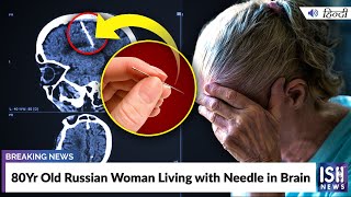 80Yr Old Russian Woman Living with Needle in Brain