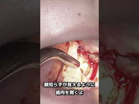 生命歯学科 早技！３秒で抜ける親知らず抜歯🦷#shorts