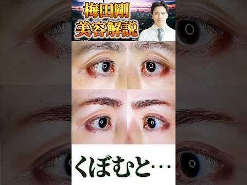 医学科 窪み目の原因は眼瞼下垂 #美容整形 #うめだ美容外科クリニック #眼瞼下垂