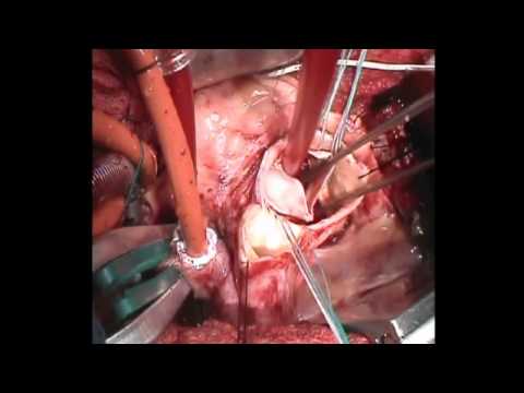Wymiana zastawki aortalnej z dostępu przez małe nacięcie