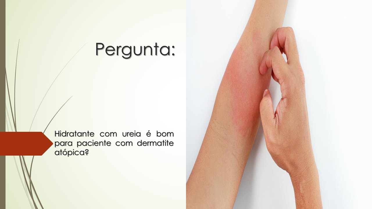 Hidratante com ureia é bom para paciente com Dermatite Atópica