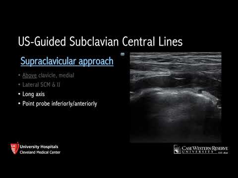 Ultrasound-Guided Subclavian Lines