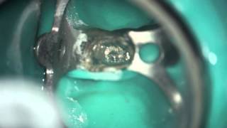 Remoción Perno del diente #15