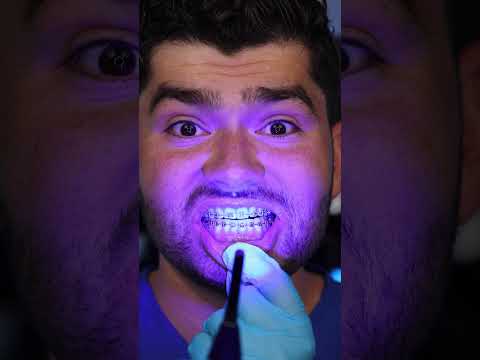 Summer Braces Hack !?