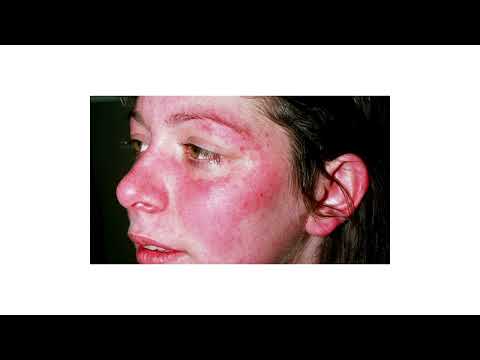 systemic lupus erythematosus in children