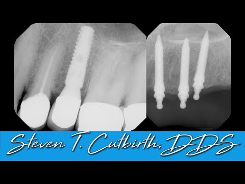 Penetration of Maxillary Sinus by Implants - with Steven T. Cutbirth, DDS