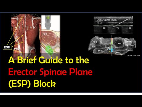 ESP Block - How To Perform It Effectively & Safely (2022)