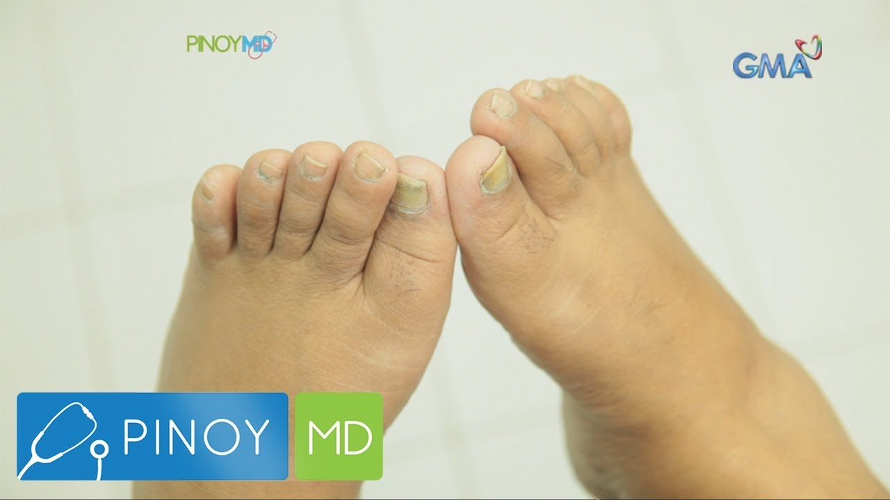 Putar video Pinoy MD: Solusyon sa nail fungus, alamin sekarang Pinoy MD: Solusyon sa nail fungus, alamin