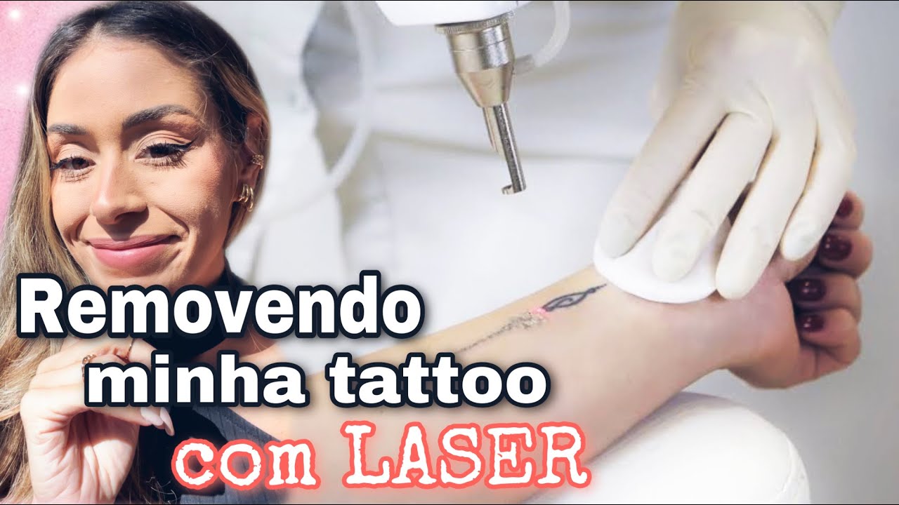Minha REMOÇÃO de TATUAGEM à laser | TUDO o que você PRECISA SABER!