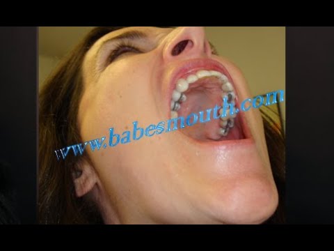 Woman at the Dentist getting implant, amalgam fillings and veneers treatment. -BabesMouth set 107