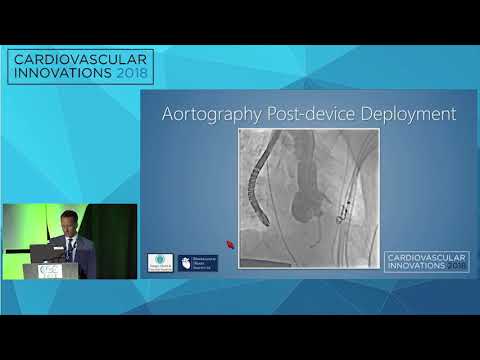 A Hail Mary: Aortic Pseudoaneurysm Closure - Jonathan Schwartz MD
