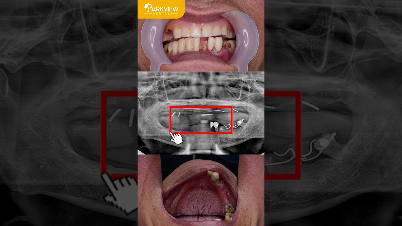 Tiêu Xương Hàm Do Đeo Hàm Tháo Lắp Lâu Năm | Giải Pháp Cấy Ghép Implant Toàn Hàm All-on-6