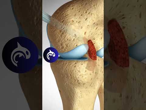 How Surgeons Fix PCL Tears: Patellar vs. Hamstring Graft Techniques - 4K 3D Animation