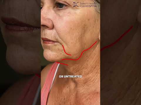 Logo of Expert Neck Lift Surgery in Bangkok, Thailand: Resolving Complex Anatomical Challenges