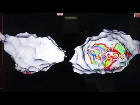 Morte improvvisa: alla Montevergine impiantato un nuovo salvavita