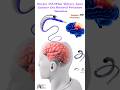 Stryker AXS Offset Delivery Assist Catheter Clot Retrieval Procedure Animation 3d Animation Short