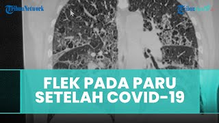 Penyebab Flek pada Paru setelah Terinfeksi Covid-19, 40 Persen Mengalami