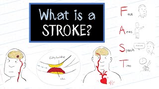 What is a Stroke? Animated Explanation Video