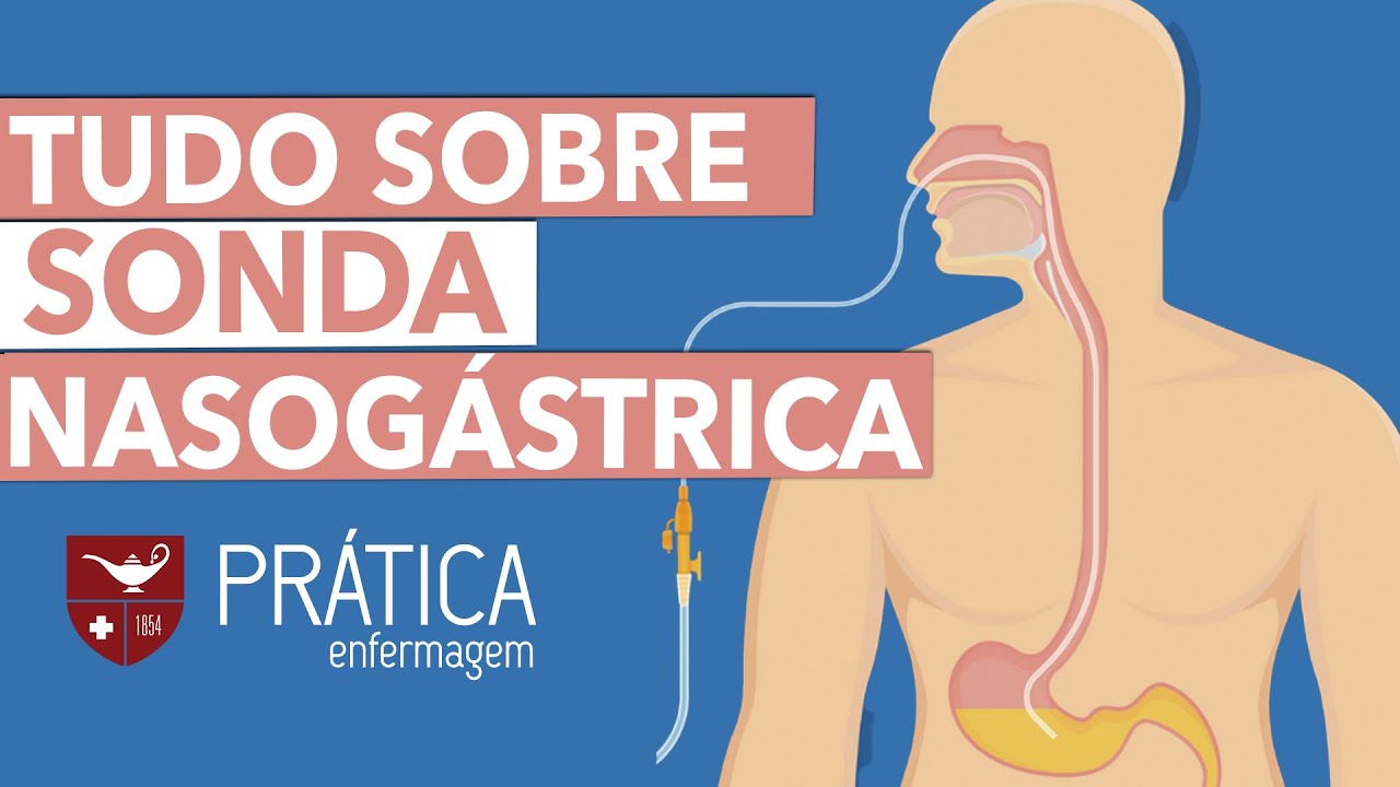 Não tenha mais DÚVIDAS sobre SONDA NASOGÁSTRICA