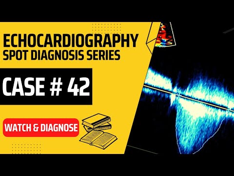 Echo Case 42: Echocardiography Spot Diagnosis Series - Learn Echo with Labelled findings