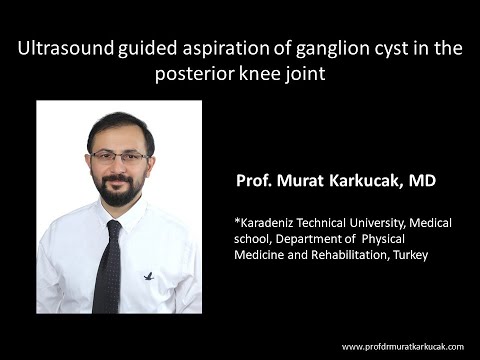 Ultrasound guided aspiration of ganglion cyst in the posterior knee joint